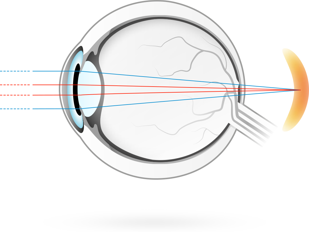 Långsynthet – uppstår när bilden bryter bakom näthinnan, vilket gör att man ser sämre på nära håll