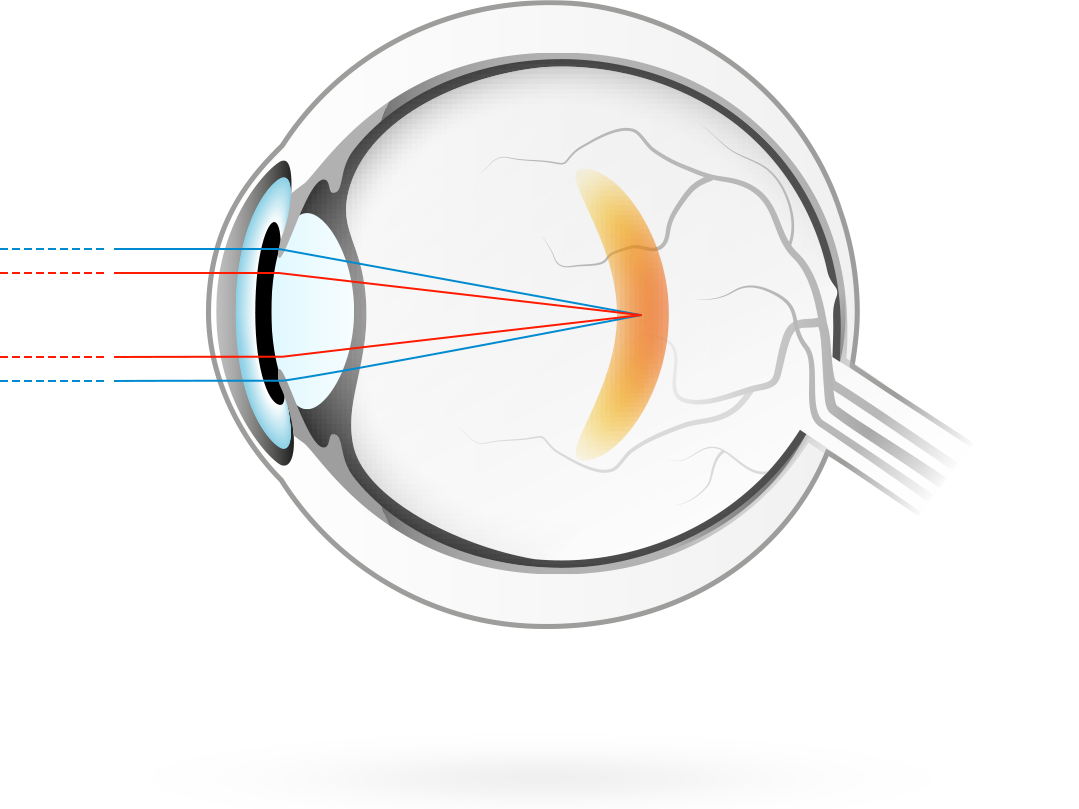 Närsynthet – uppstår när bilden fokuseras framför näthinnan i ögat, vilket gör att man ser sämre på längre avstånd