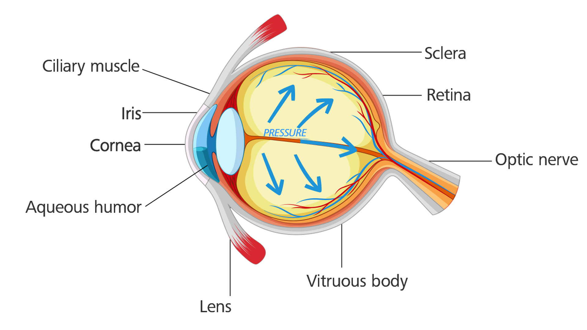 Öga med grön starr: ögontrycket byggs upp och skadar synnerven.