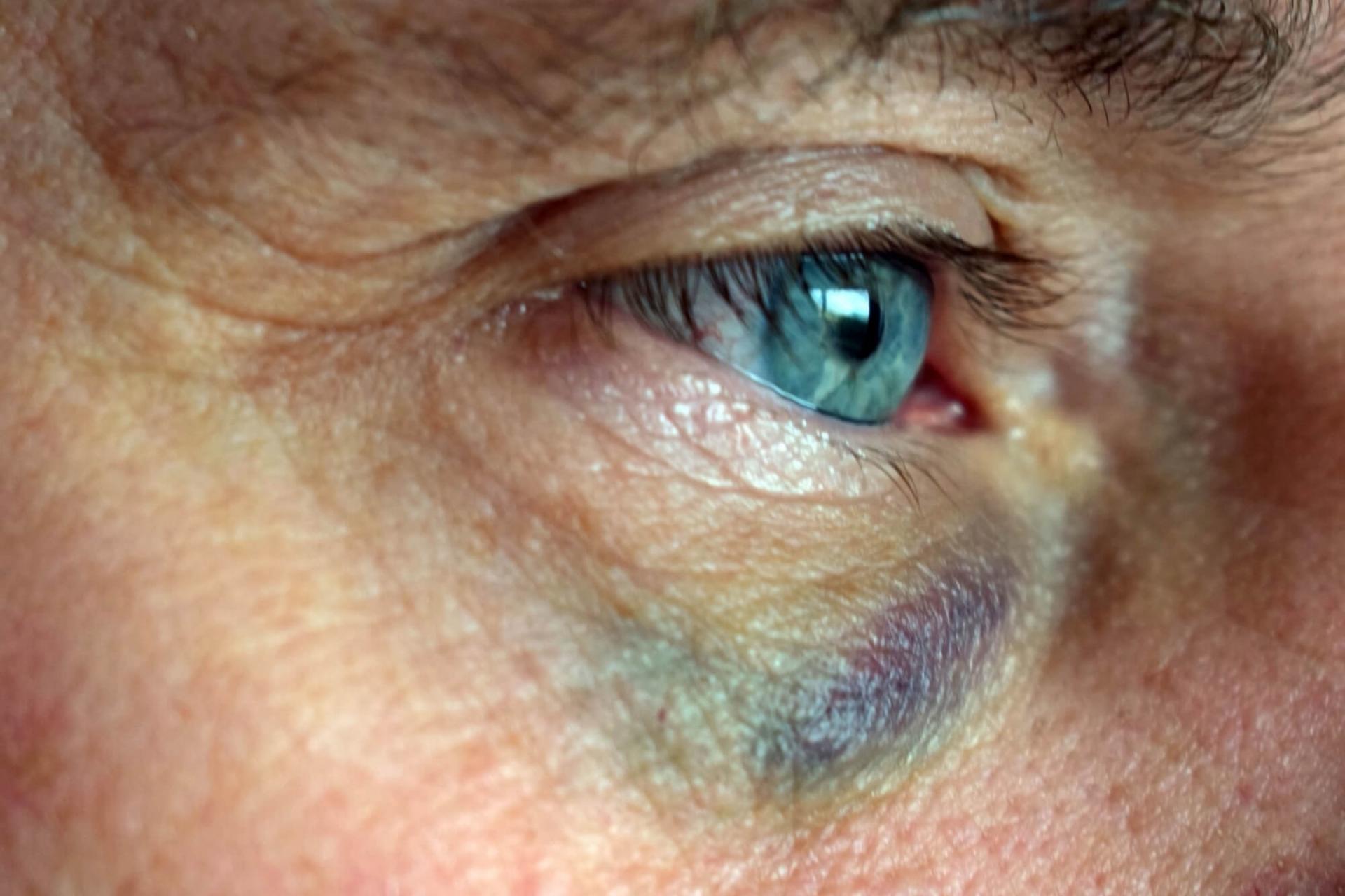 Blodkärlen i ögat kan brista om ögat utsätts för trubbigt våld och den vita delen av ögat (sklera) ser röd och blodsprängd ut.