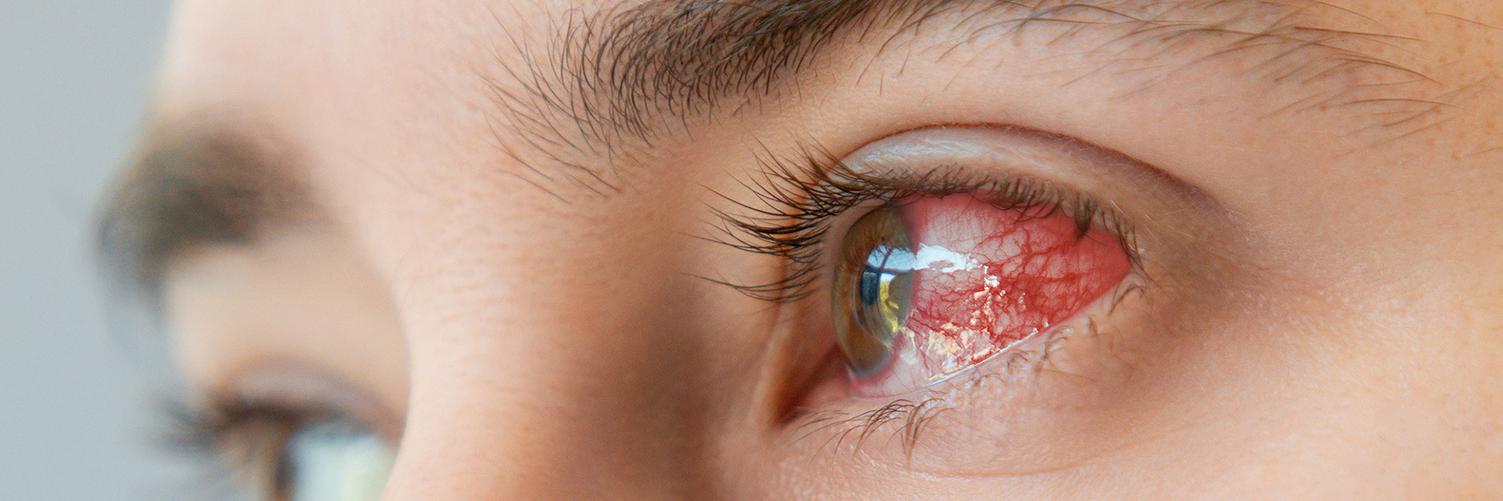 Close up of male brown bloodshot eyes and redness with vessels. Loremipsum