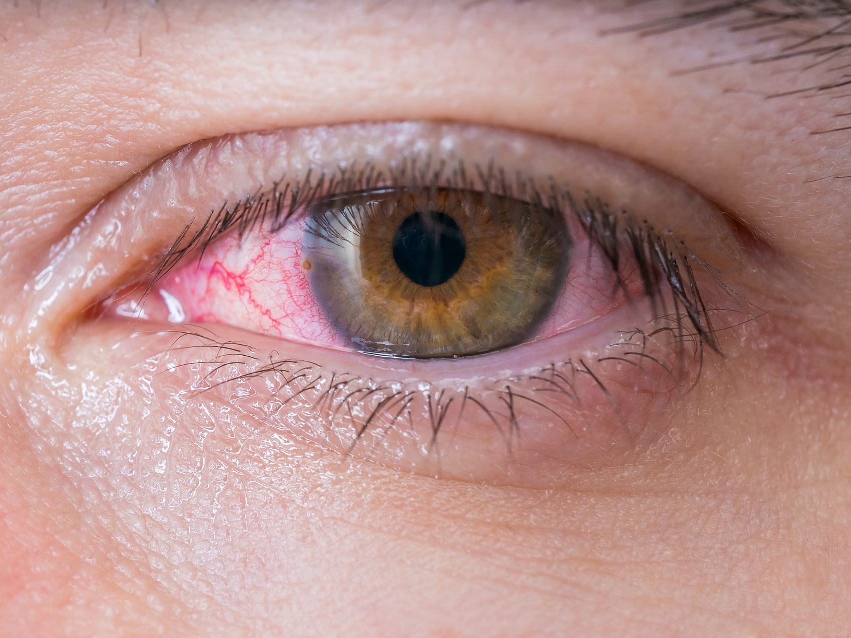 På denna bild visas en närbild av ett ohälsosamt öga som visar hur potentiella ögonrisker kan se ut. 
